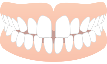 空隙歯列